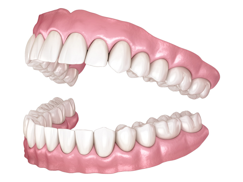 services-complete-dentures Traditional Dentures