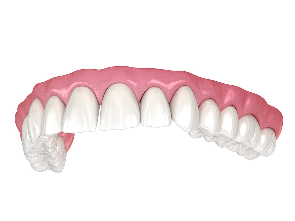 services-immediate-dentures Immediate Dentures