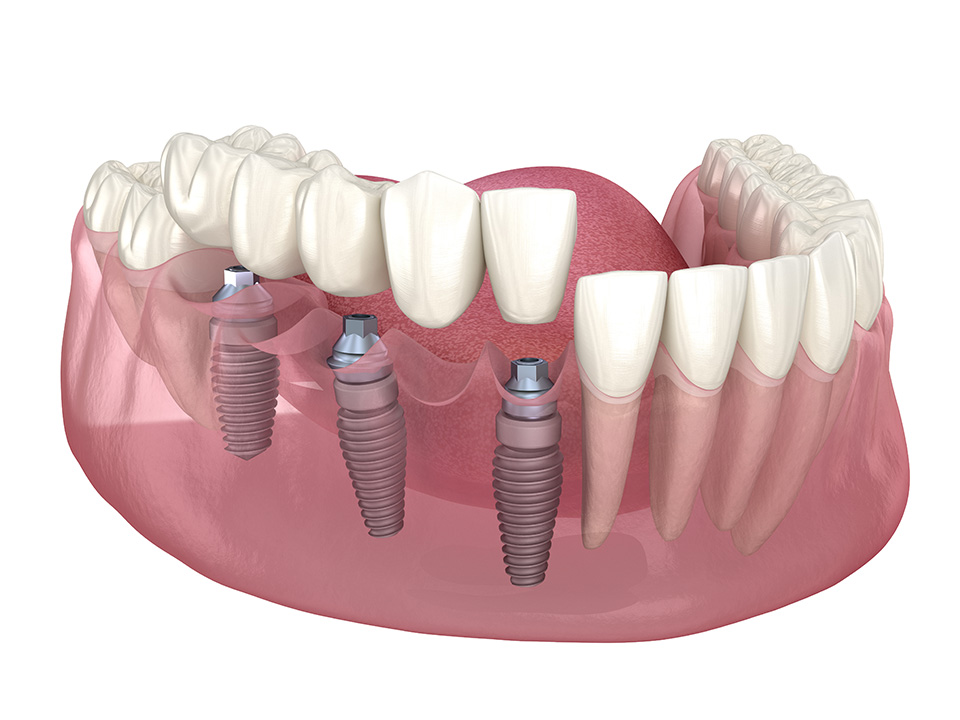 Multiple Dental Implants Dental Implants