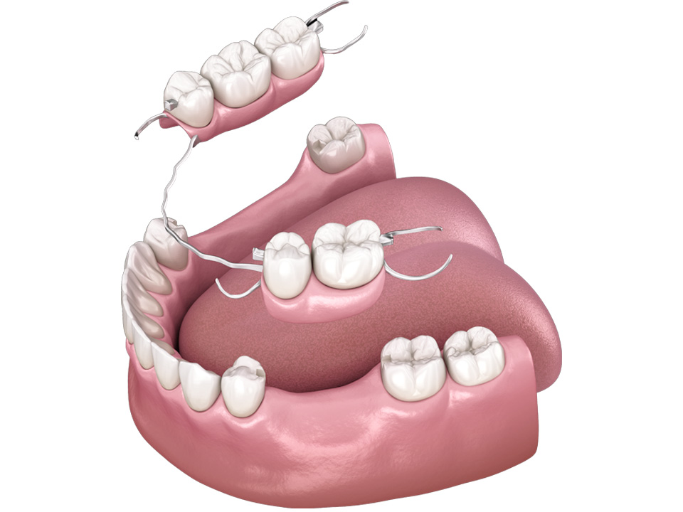 services-partial-dentures1 Partial Dentures