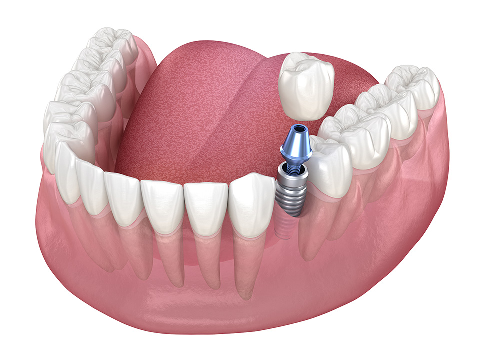 Single Dental Implant Dental Implants